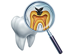悪化した虫歯を抜歯から救う治療～根管治療～